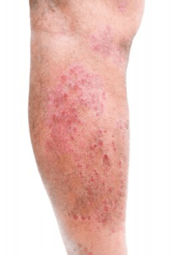 atopic eczema on leg