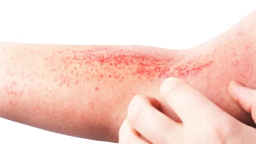 atopic eczema inside elbow